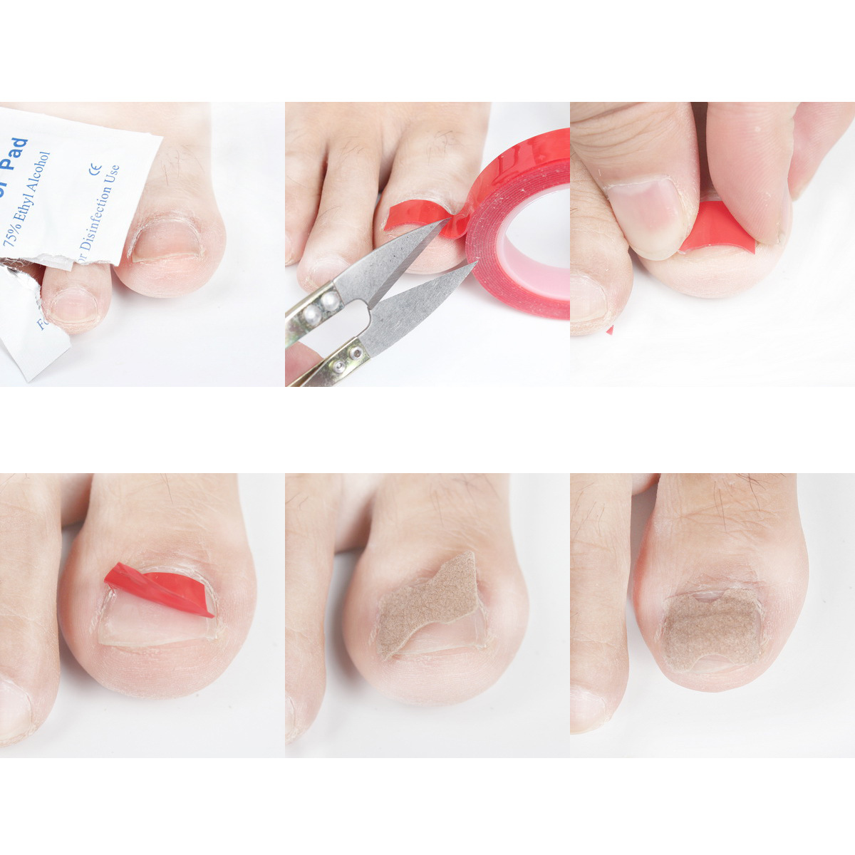 双面胶正甲贴 嵌甲矫正贴片拉拉贴甲沟贴嵌甲矫正器