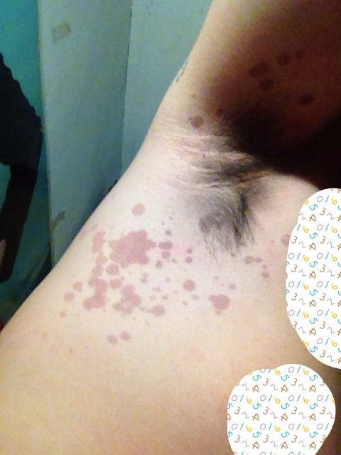 腋窝长满褐色斑点,有皮屑偶尔会痒?腋窝汗斑癣?