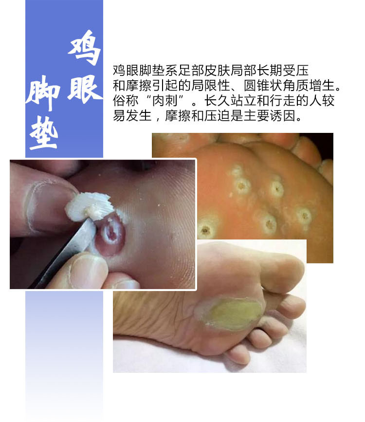 瘊疣鸡眼膏 肉刺 脚垫 老茧脚裂除脚趾 祛瘊子跖疣液净脚垫贴牌