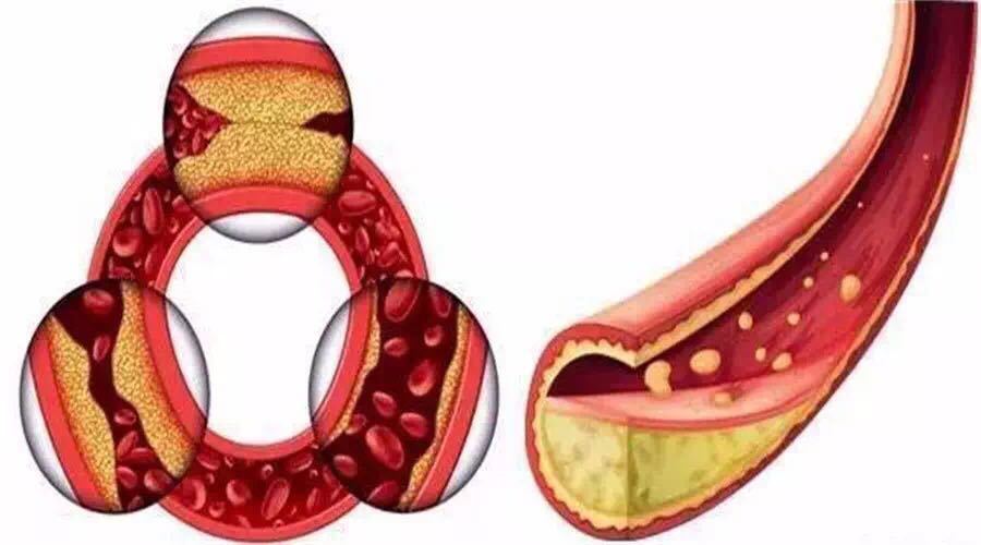 高血脂有五个表现症状,快看看你的血脂还正常吗?