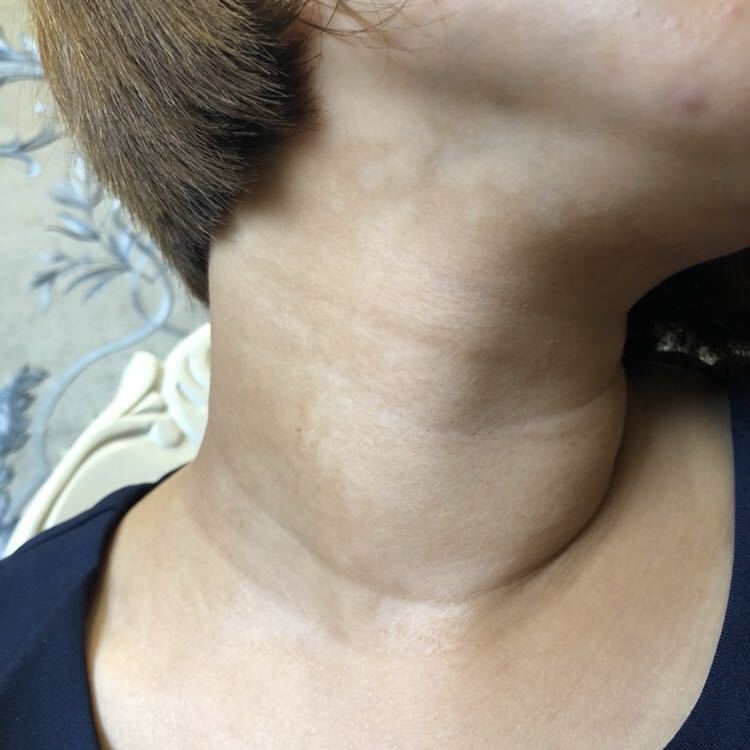 脖子腋下白黑色色斑点汗斑花斑癣,胸前背后胳膊也有