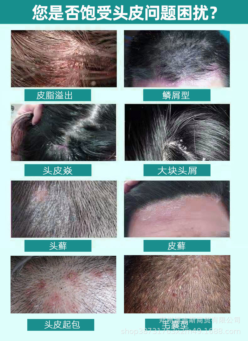 百草屑藓灵霸屑祛屑头皮痒护理洗发水头屑康灵头皮藓毛囊