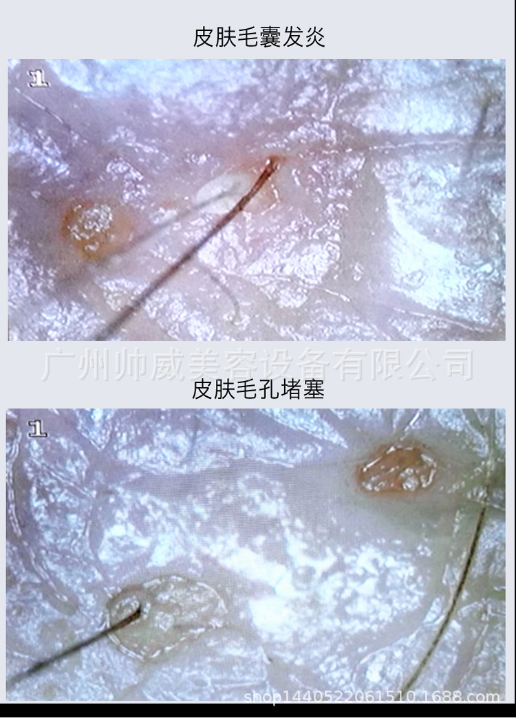 工厂直销帅威丑小鸭9寸皮肤毛孔毛发毛囊皮肤头皮检测仪器带屏幕