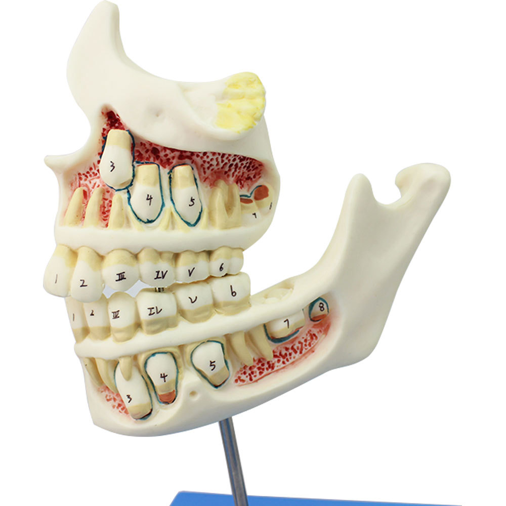 医信牙与颌骨的发育模型牙齿病变模型牙齿模型