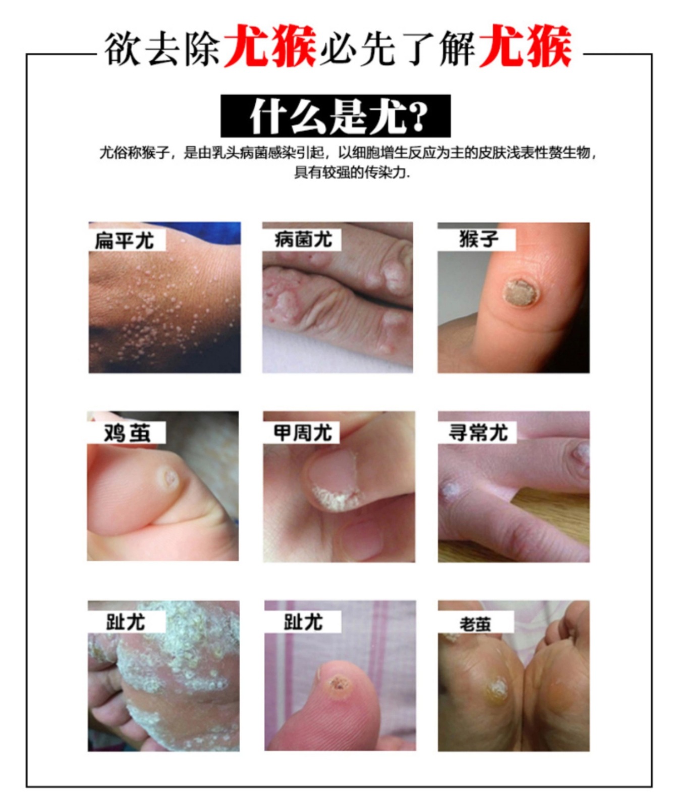 地摊货源oem鸡眼液剥茧生物膜去鸡眼膏除脚趾祛瘊子跖疣液鸡眼液