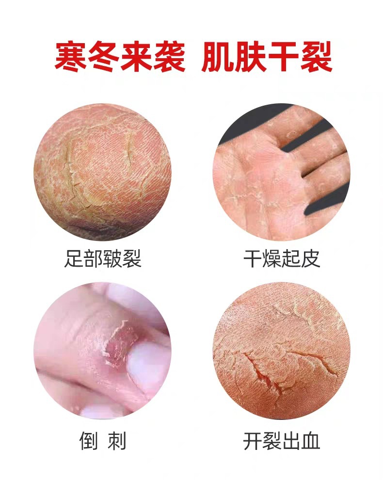 联系客服仁和冻疮膏100g手足开裂冷敷凝胶防冻伤伤口护理软膏