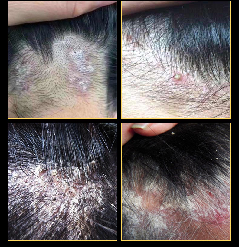 力克宁洗发水去屑头部脂溢性毛囊清洁皮肤发用液套装 厂家批发