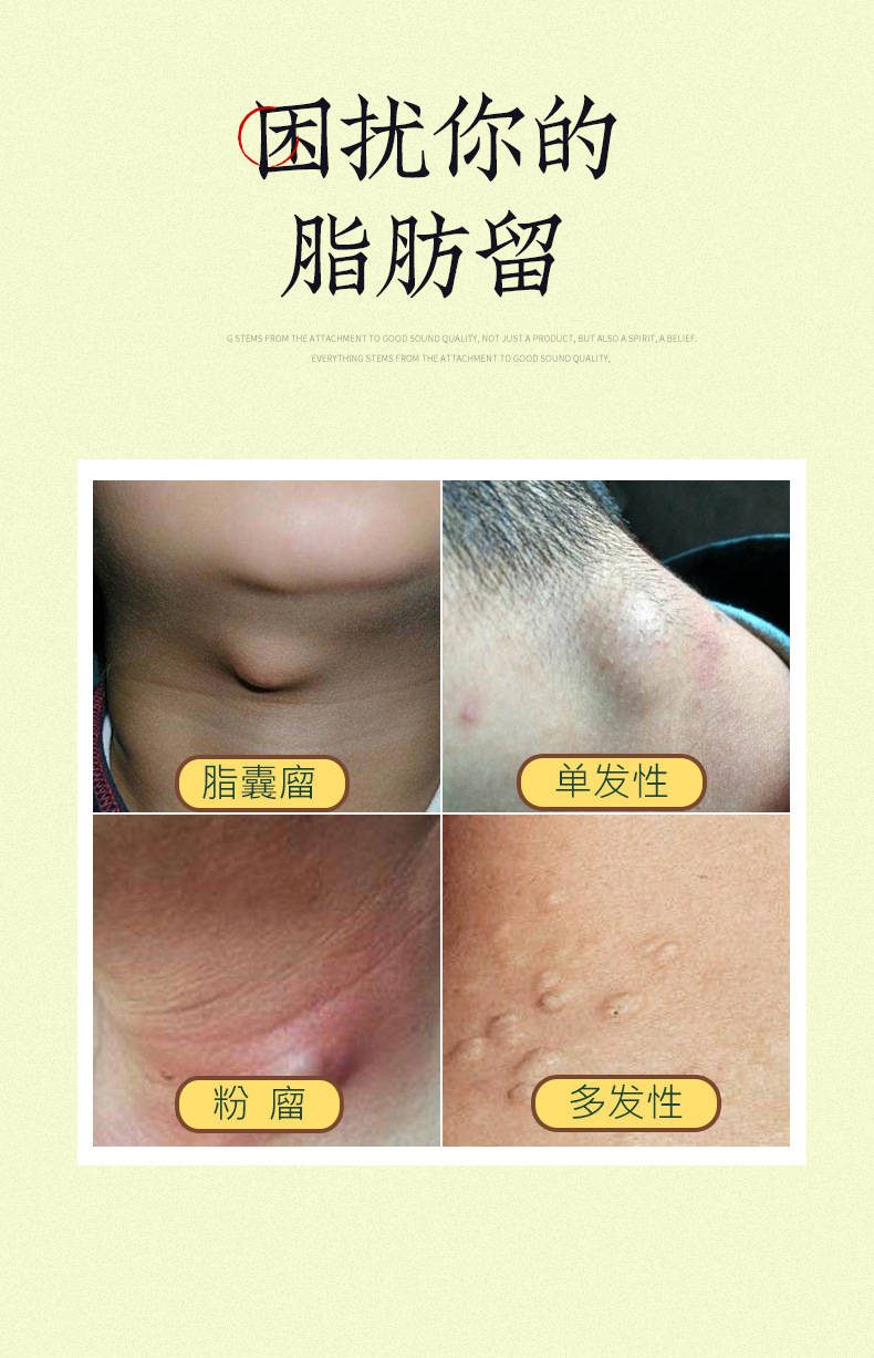 脂肪膏瘤液皮下脂肪留膏硬块全身发多单性膏脂肪贴贴消瘤膏液