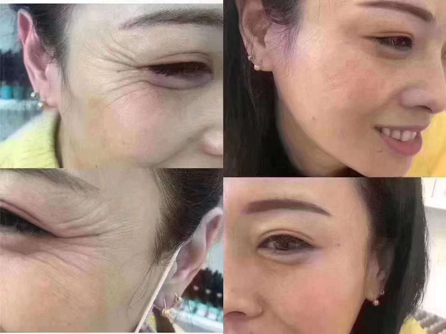 做完干细胞去皱能做美容吗的简单介绍