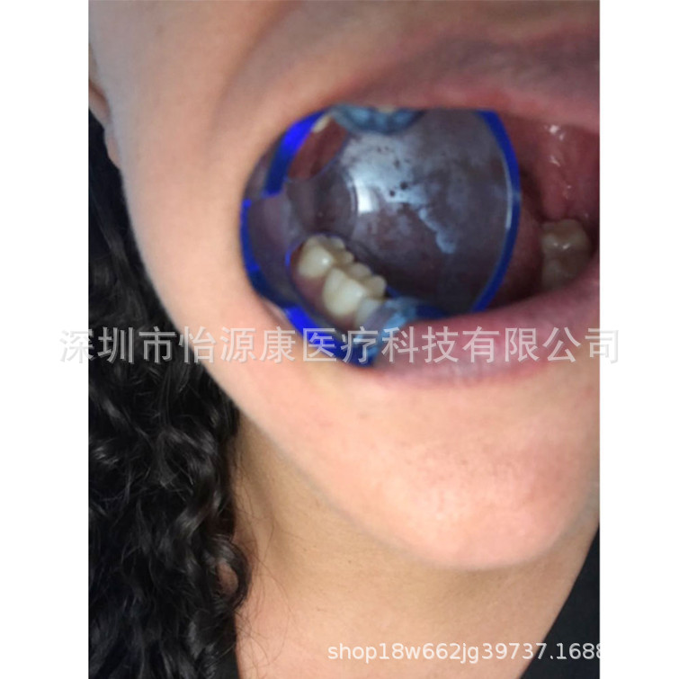 新型牙科前牙后牙开口器 支撑器 正畸开口器 塑料开口