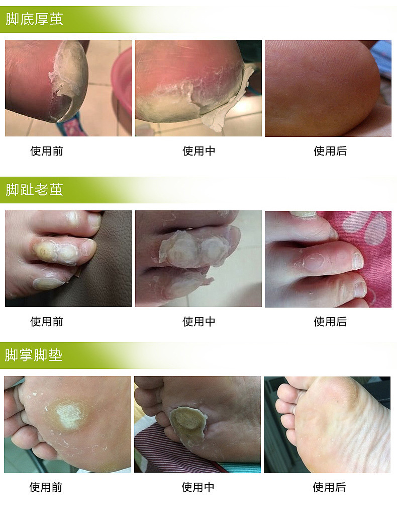 玛卡金恩生物膜去鸡眼膏除脚趾老茧贴祛瘊子跖疣液脚茧净脚垫脚底