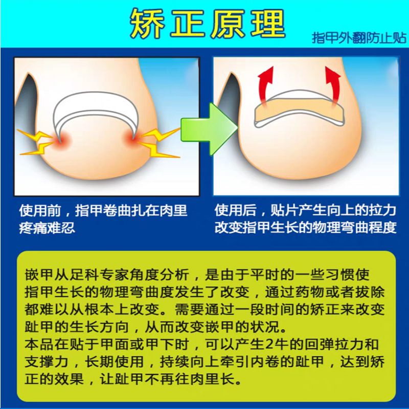 免胶水嵌甲矫正贴 脚指甲正甲贴甲沟炎嵌甲矫正器贴片 矫正指甲