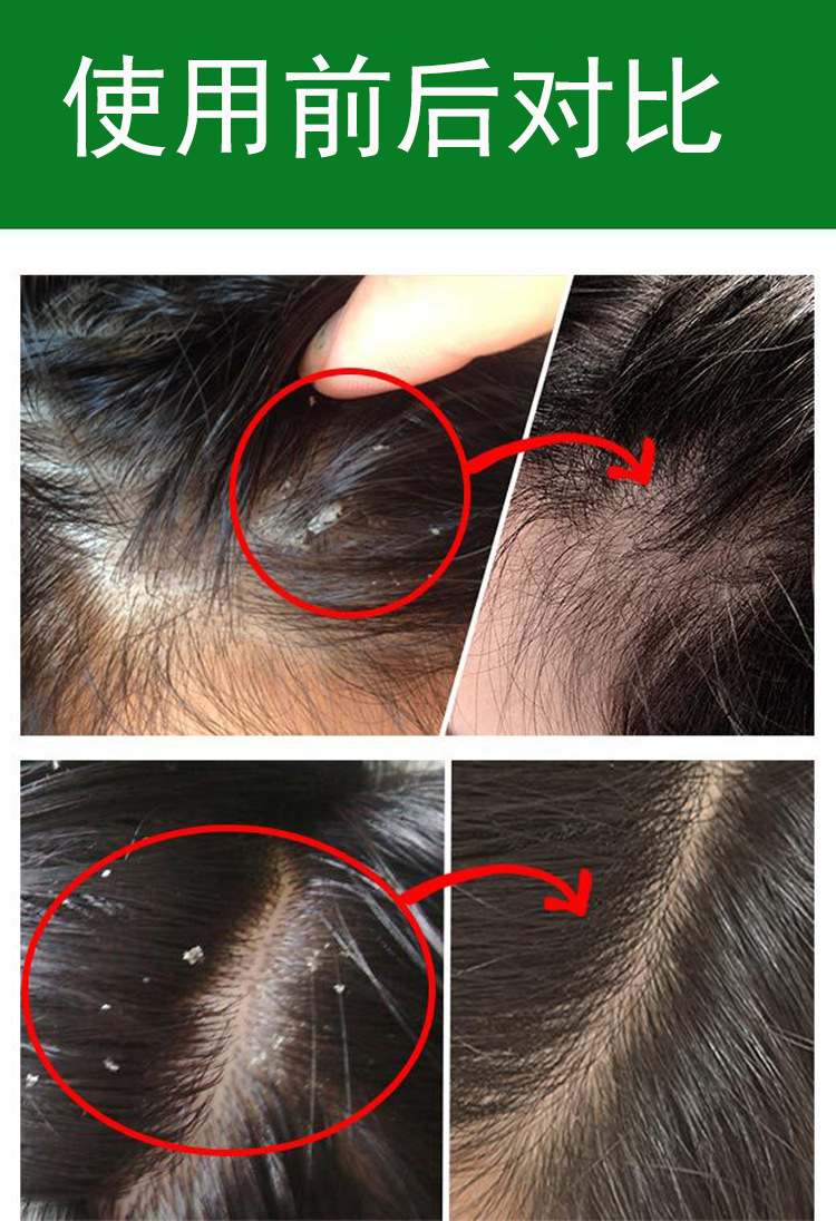 屑康灵去屑洗发水深层清洁去头屑止头痒洗发液控油清螨草本洗发露