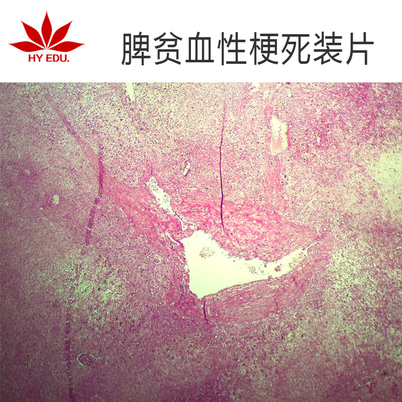 脾贫血性梗死生物切片人体病理切片显微镜配套生物切片