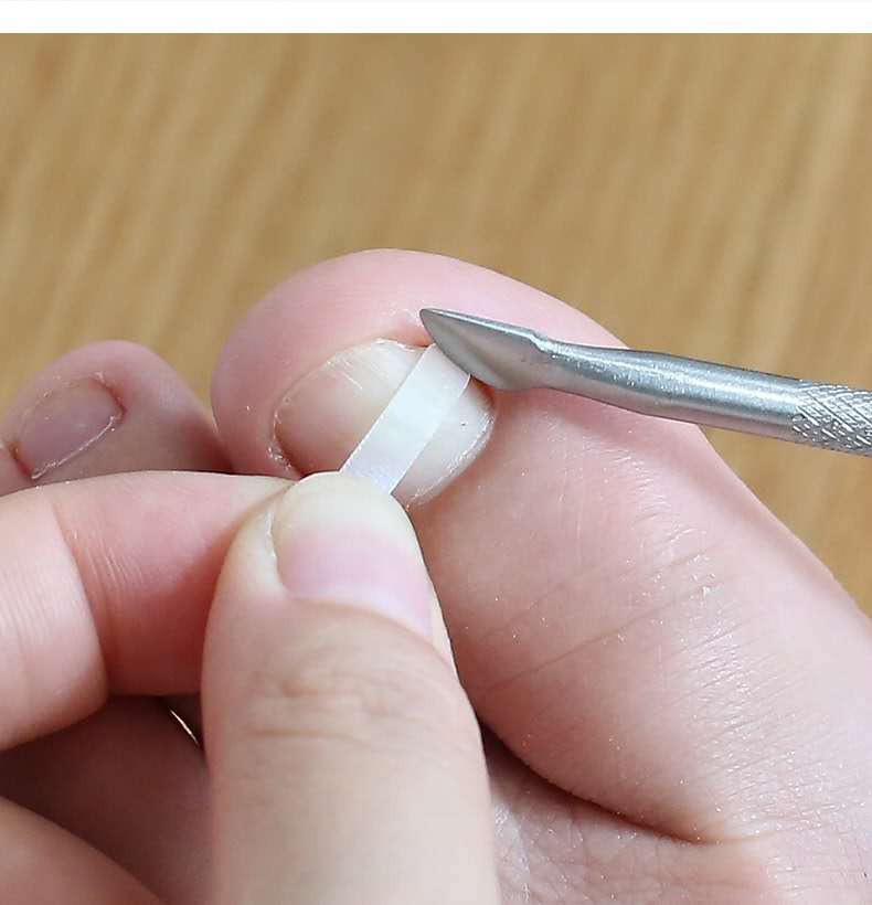 正甲贴精装30片中性套盒嵌甲矫正贴片甲沟拉拉贴脚指甲弹厂批