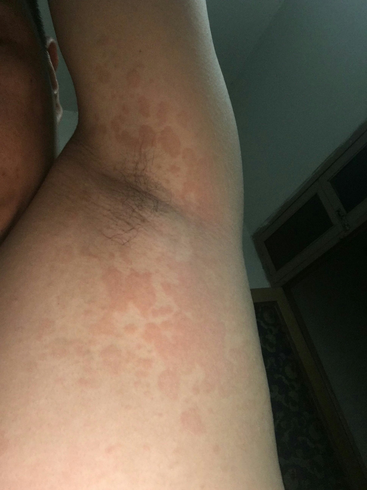 腋窝里长汗斑花斑癣,腋窝汗斑好根治吗?