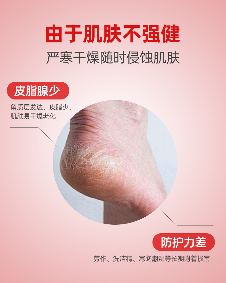 厂家直销 手足裂开型冷敷凝胶 冻疮膏 防冻伤祛红消肿 100g