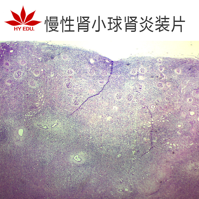 慢性肾小球肾炎生物切片人体病理切片显微镜配套生物切片