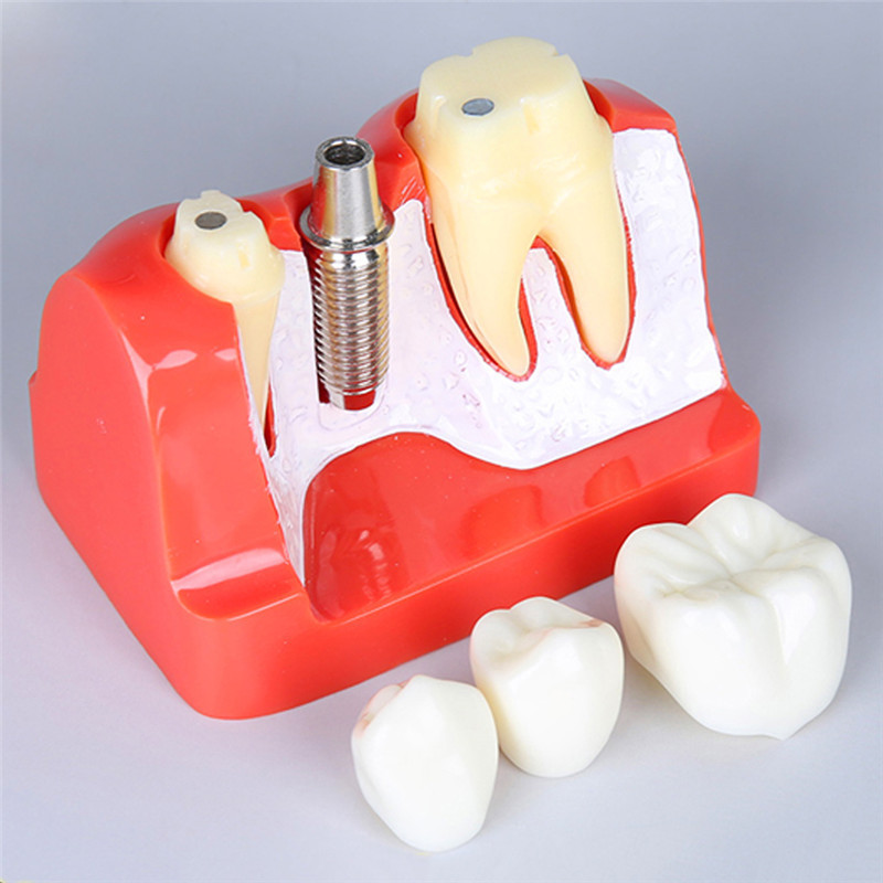 4倍牙模型牙种植体分析冠演示牙模型 种植体分解模型口腔教学模型