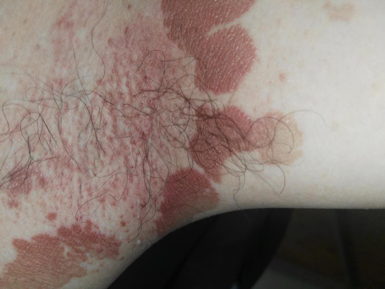 如何根治褐色汗斑花斑癣?