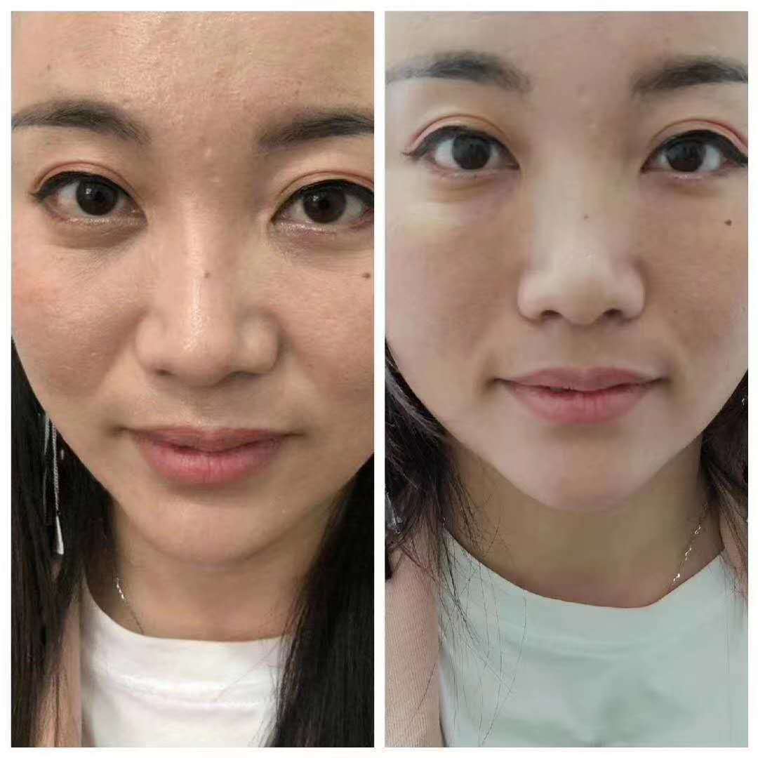 暨大4ml干细胞填充凹陷祛眼袋泪沟下巴创科深导抗衰冻干粉4万单位