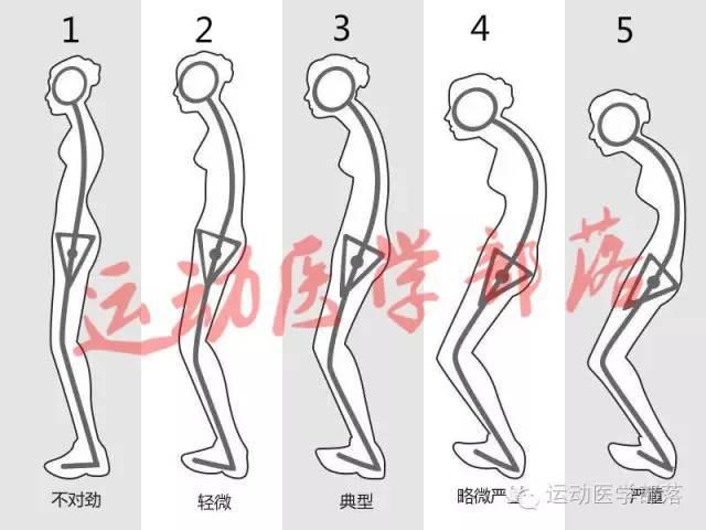 原来驼背分很多种,怎样矫正训练更有效?