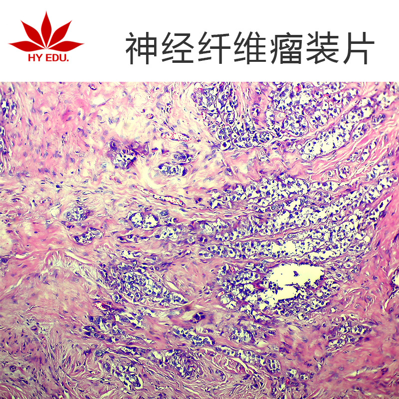 神经纤维瘤生物切片病理切片显微镜配套生物切片