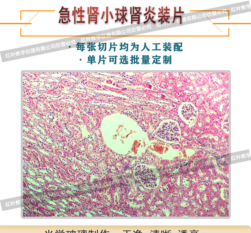 急性肾小球肾炎生物切片人体病理切片显微镜配套生物切片
