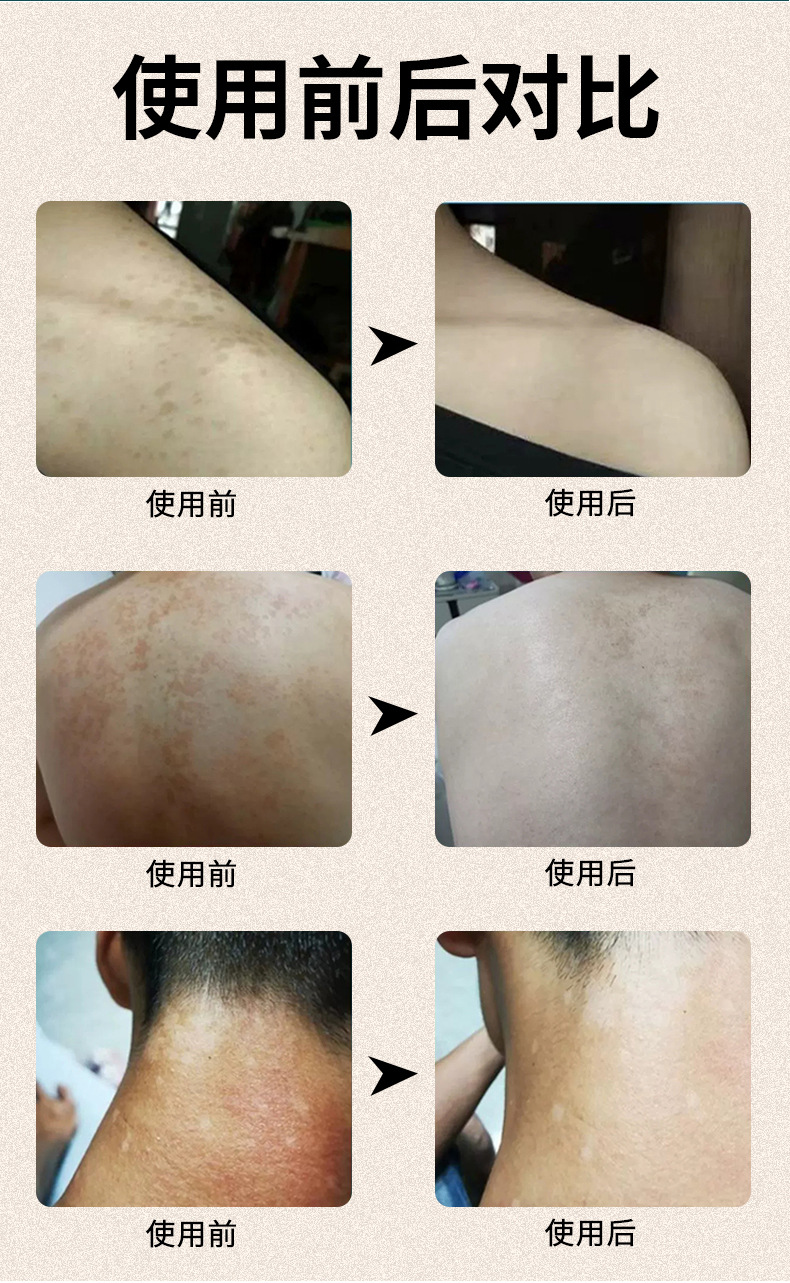 妙丹堂汗斑净 汗斑露 白斑花斑癣白癜风补骨脂止汗抑菌液