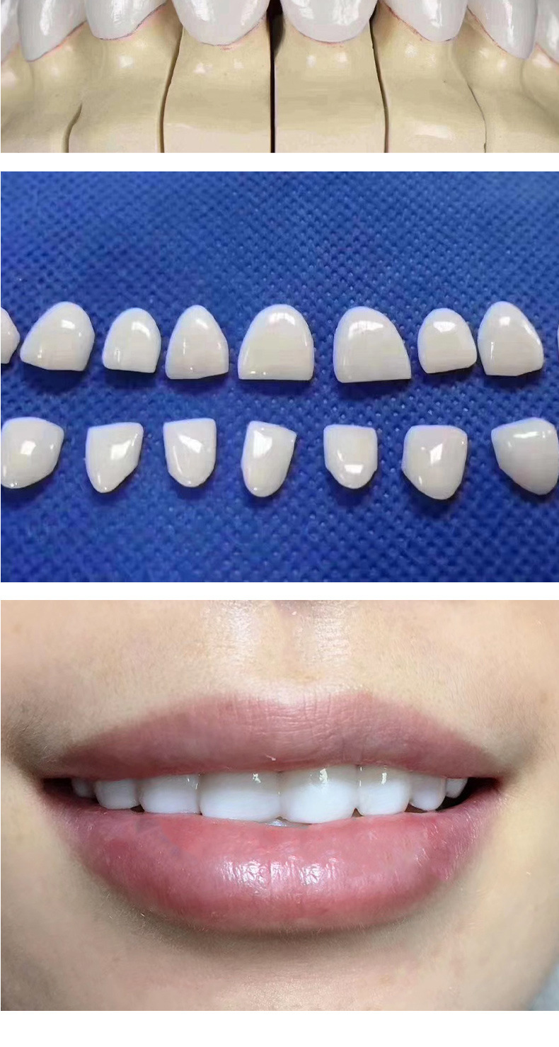 牙齿牙贴 牙齿全瓷贴面美牙贴炫白牙贴去黄去污贴 牙齿套装