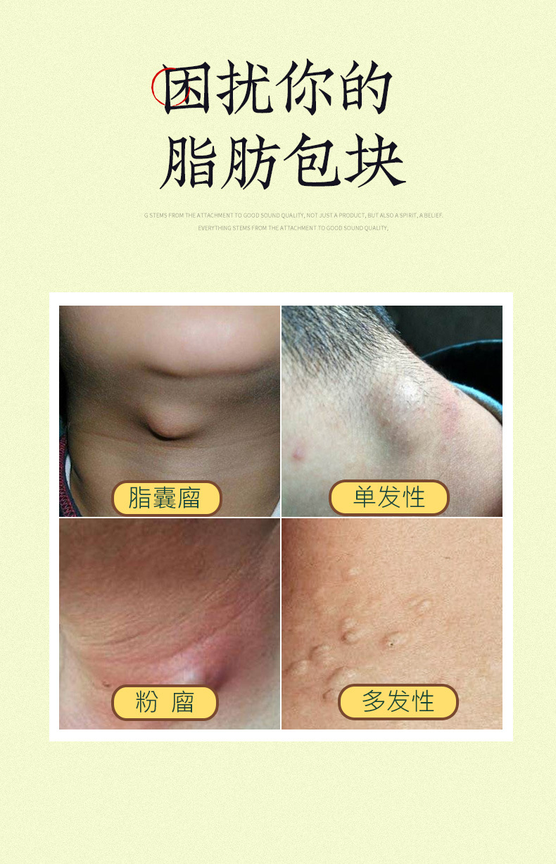 脂肪瘤膏去除皮下脂肪包块硬块全身发多单性克星脂肪贴消瘤膏