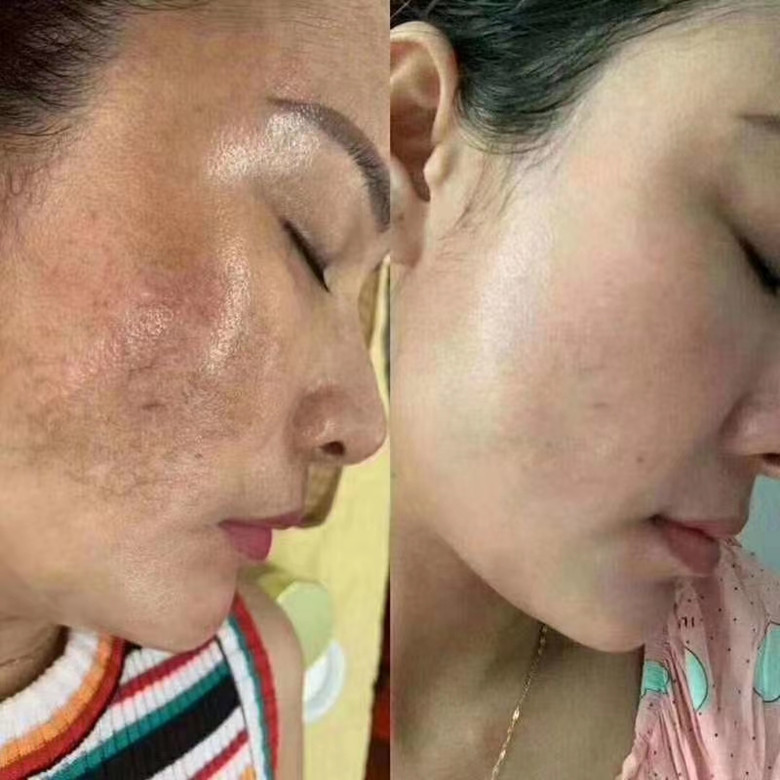 水分离术无创微晶溶斑液溶斑色沉雀斑痘印导入铅汞斑商用斑