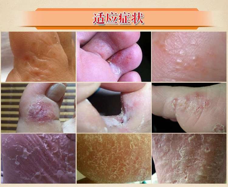 草本癣足清脚臭脚气喷剂脚痒止痒膏套装源头厂家一件代发