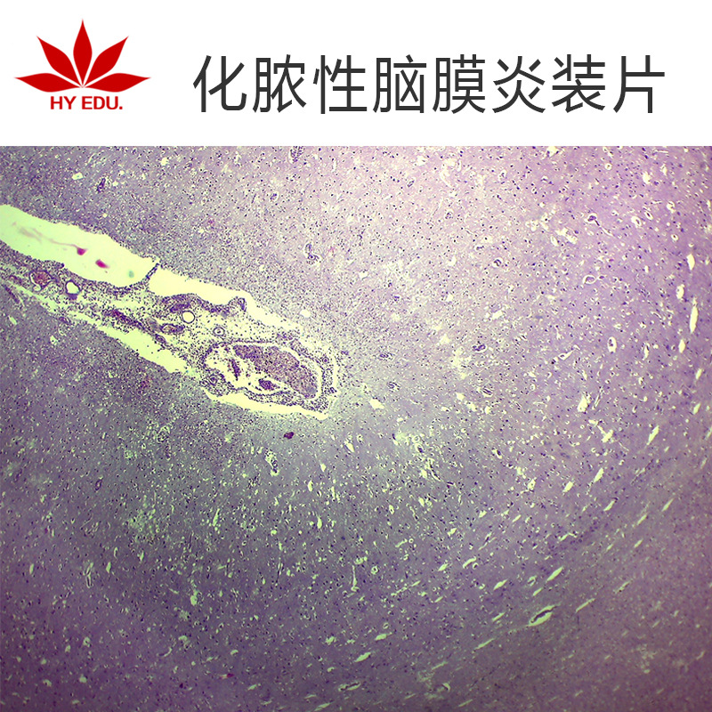 流行性乙型脑炎切片图片