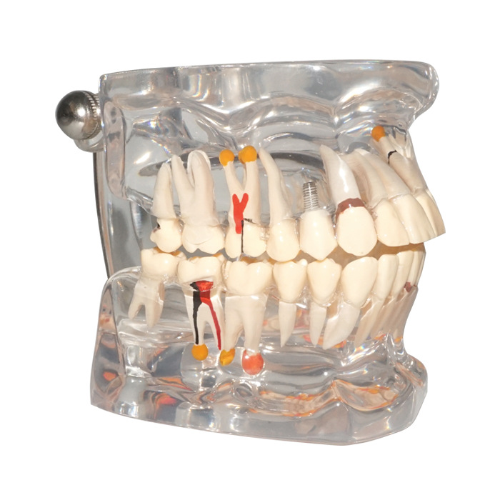 透明蛀牙模型 牙齿生长模型 可拆牙齿模型