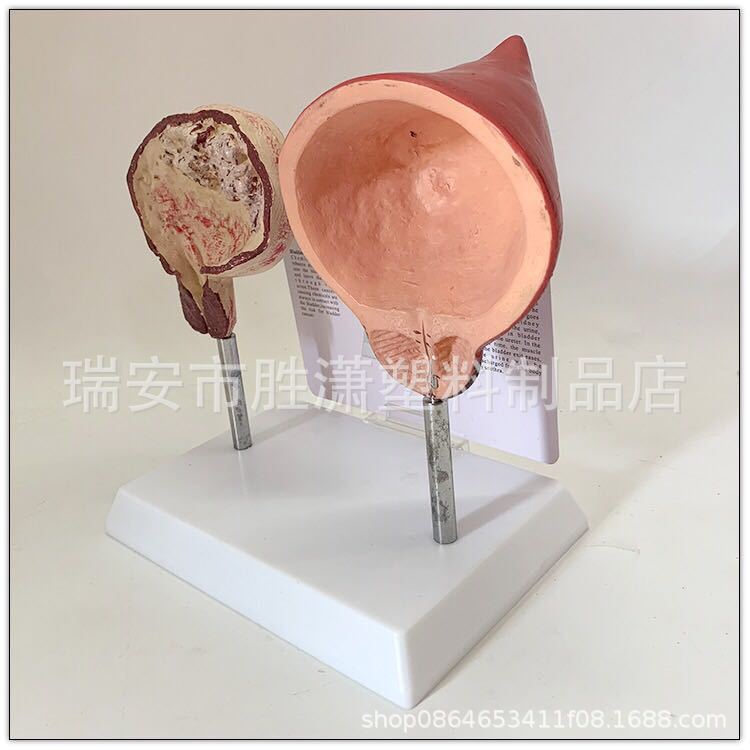 人体健康膀胱与吸烟膀胱对比模型 病理膀胱 解剖膀胱生殖系统膀胱