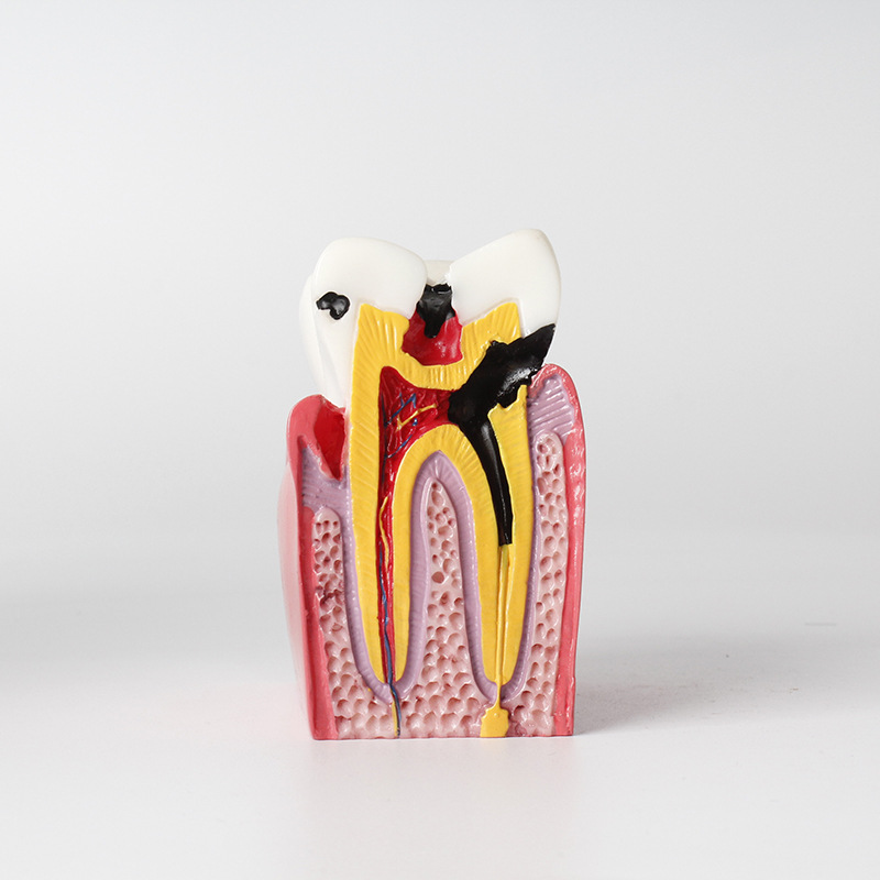 6倍龋齿放大模型牙齿柱牙根管龋齿双侧对比牙模口腔教学演示模型