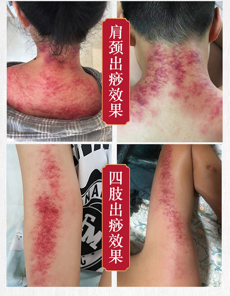 专利款一件代发宫氏碳化四件套浪款擀筋棒榉木点穴刮痧按摩擀筋棒