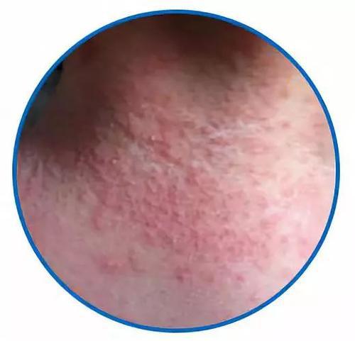 宝宝长痱子,这样护理简单又好的快!