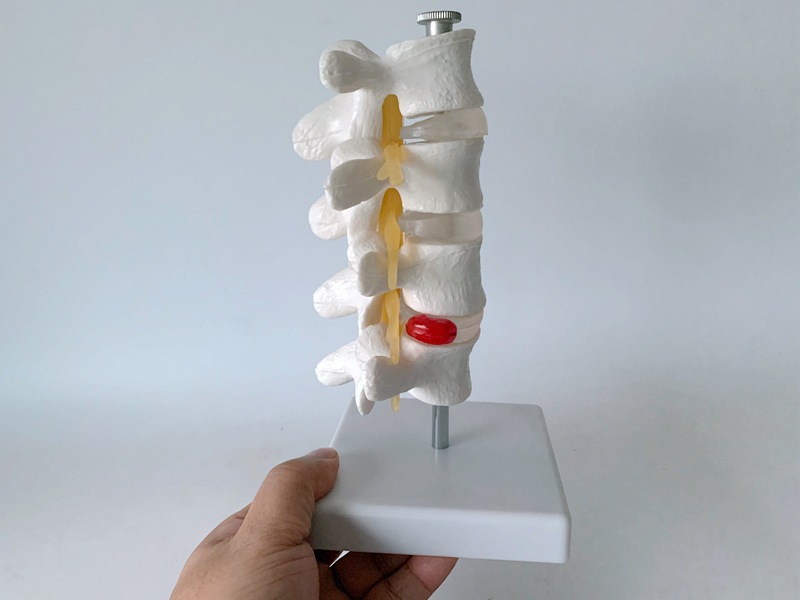 四节人体腰椎带病变椎间盘突出模型脊椎神经1:1可拆4节骨骼骨架