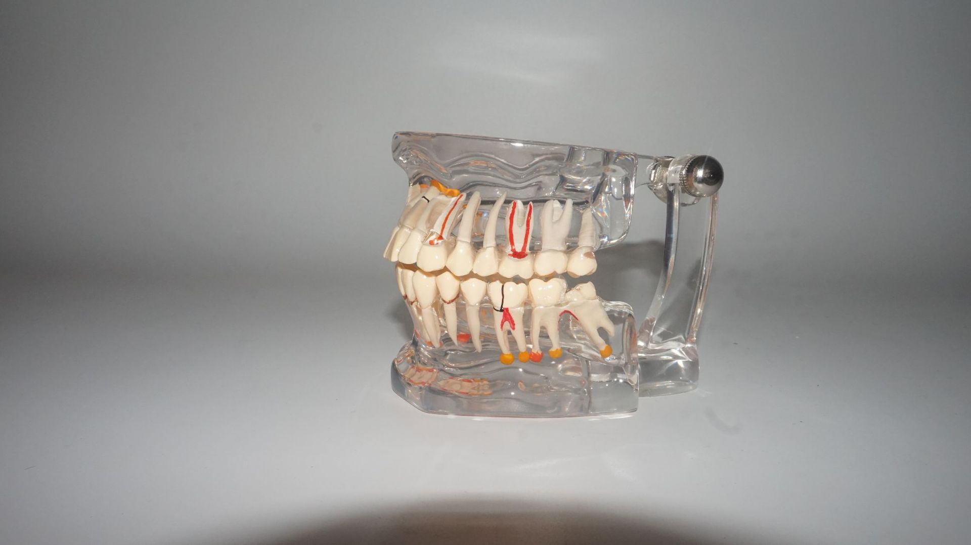 透明蛀牙模型 牙齿生长模型 可拆牙齿模型