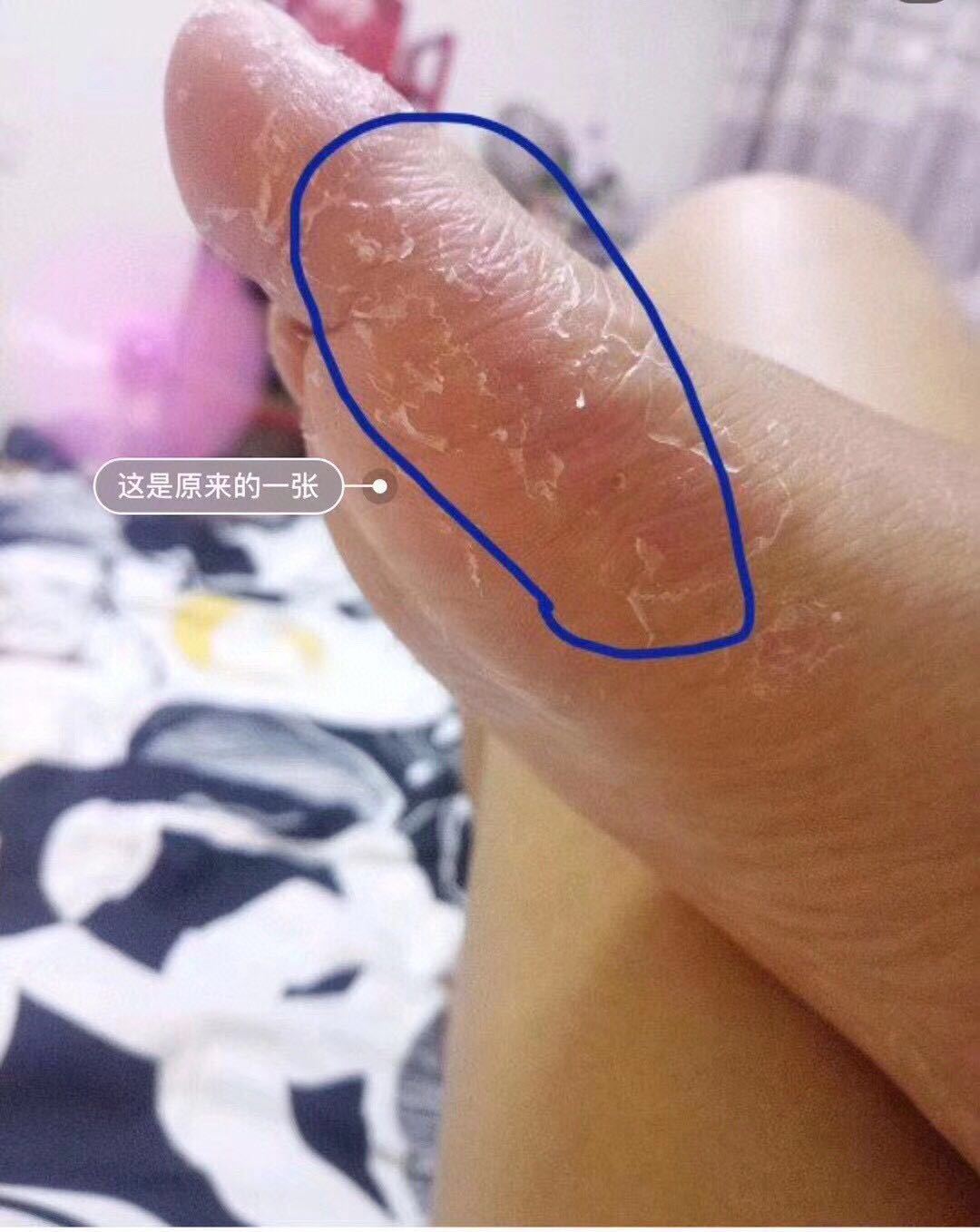 linda脚气膏20g 手足藓 体藓 脚痒脱皮起泡止痒软膏一件代发