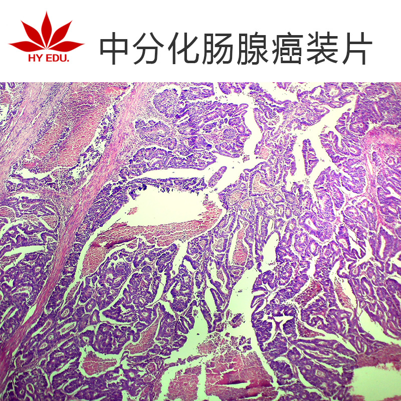 中分化肠腺癌生物切片病理切片显微镜配套生物切片