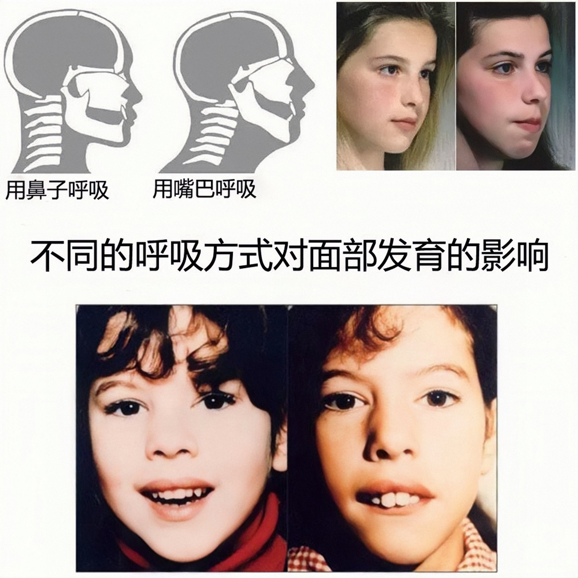 南通优玖夜间x型防打鼾贴 防张口打呼噜梦话呼吸贴儿童打鼾