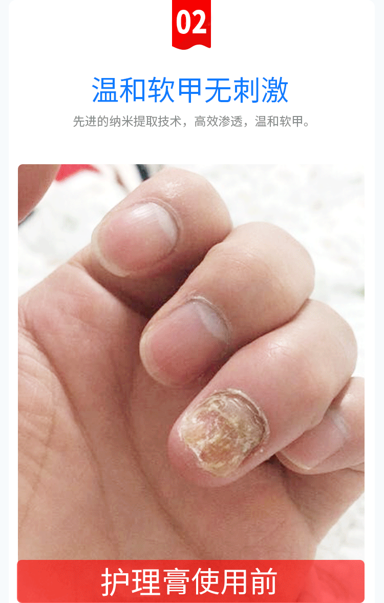 九福堂亮甲灰指甲液趾指甲生长液套装软膏oem灰甲修复液现货批发