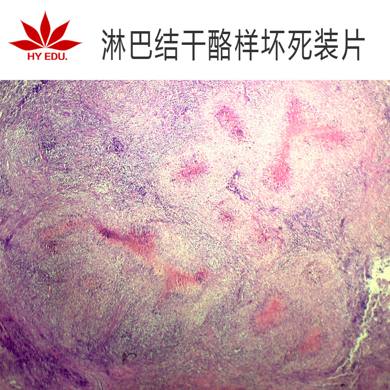 高教单片可售人体病理淋巴结干酪样坏死切片标本生物切片医学教学