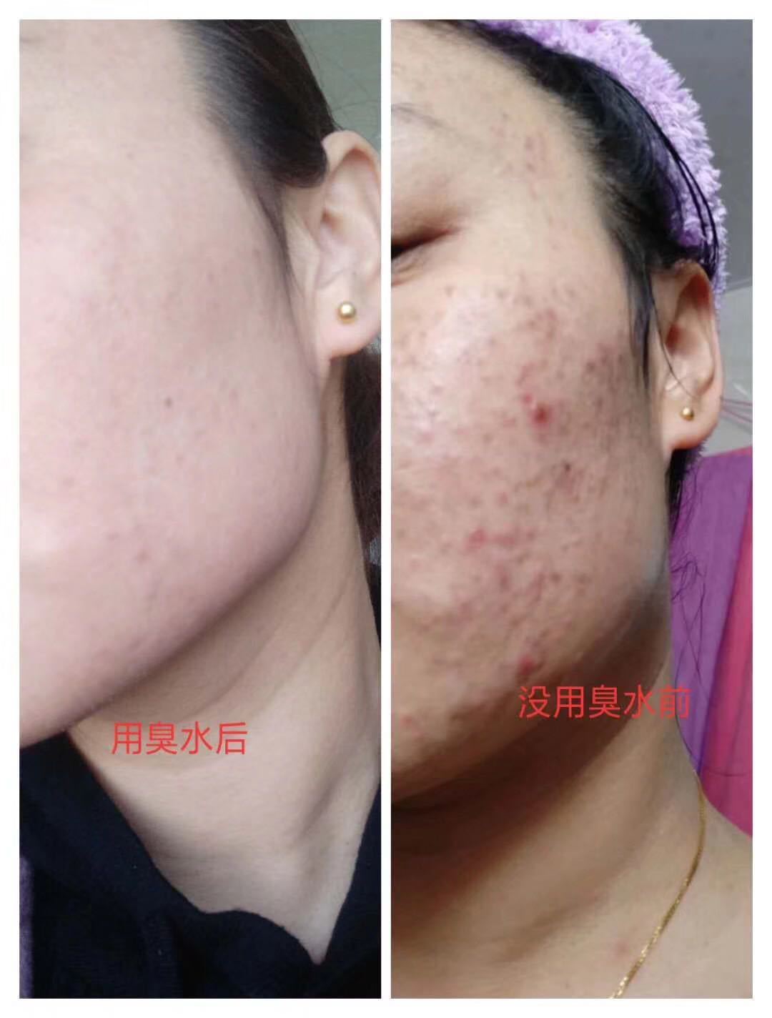 草本臭臭水 排铅汞斑去黑头祛痘多重功效草本疏基水oem贴牌代加工