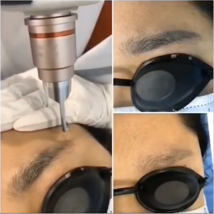 洗眉头洗纹身黑科技美容院通用无痛不破皮光感洗眉机源头工厂直销