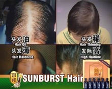 正品新首邦育发液sunburst国际版溢脂性防脱控油斑秃密增生发液