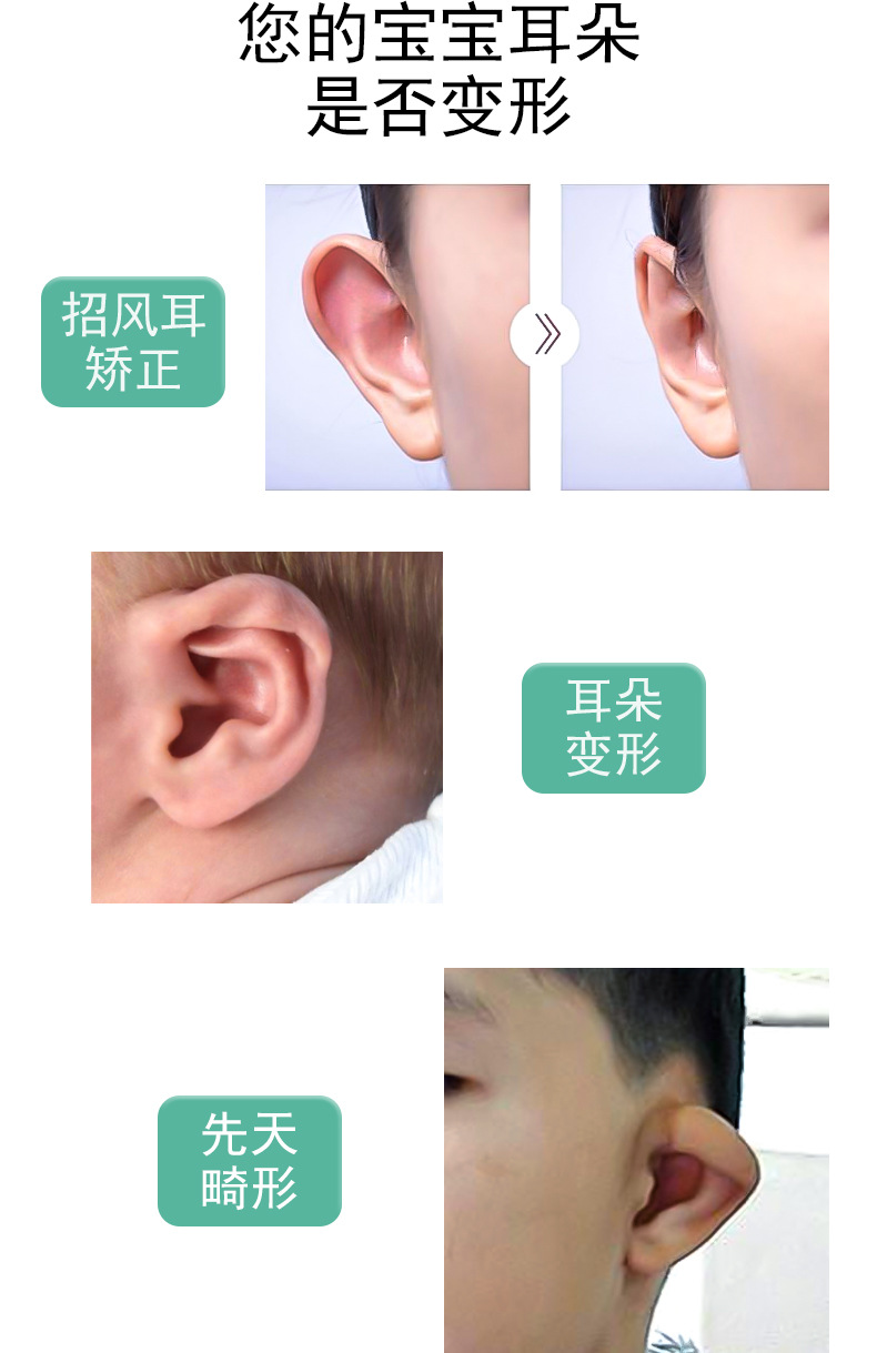 自粘硅胶胶带耳朵矫正器新生儿婴儿宝宝畸形矫形招风垂耳廓矫正贴